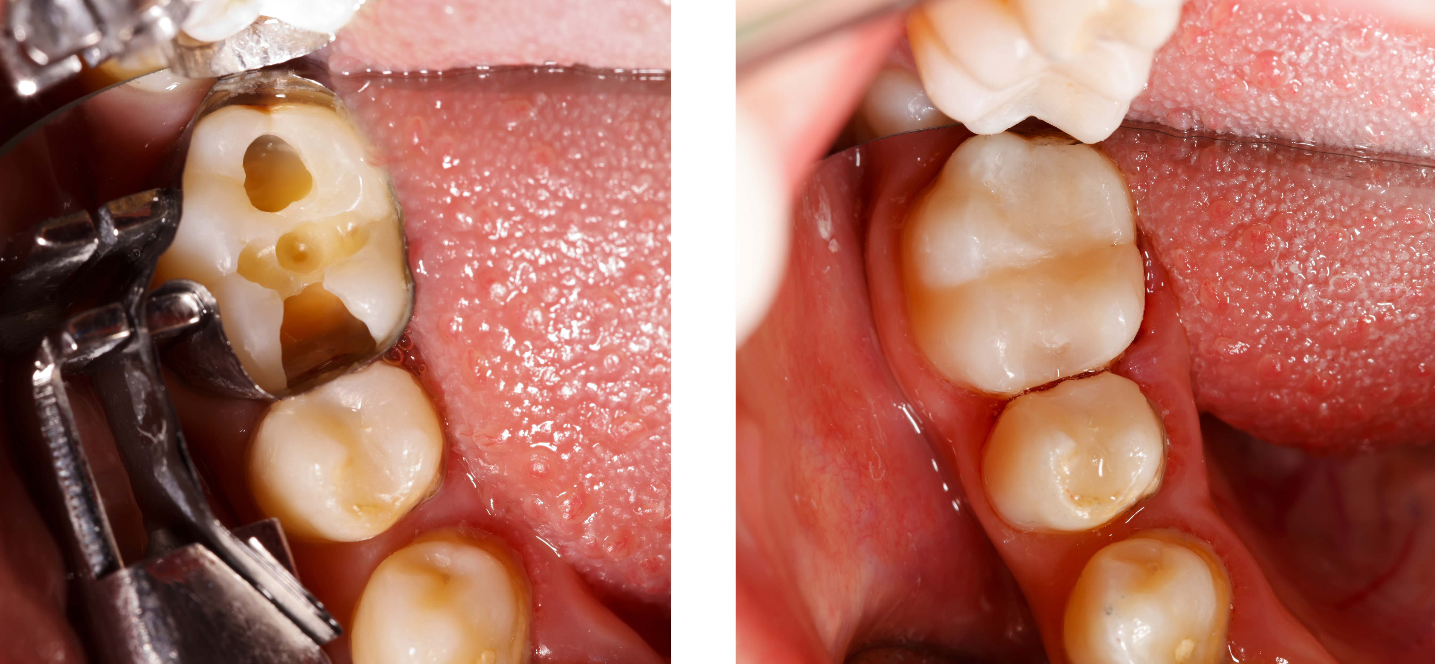 , Composite Fillings