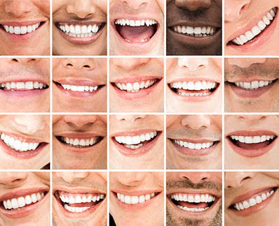, Smile Makeover