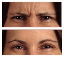 , Facial Rejuvenation / Anti-Wrinkle Treatment