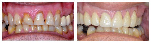 , Smile Gallery: Crowns