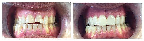 , Smile Gallery: Veneers