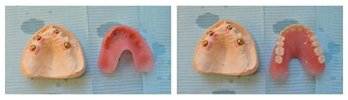 , Smile Gallery: Dental Implants