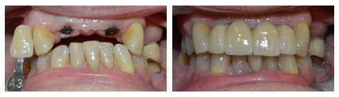 , Smile Gallery: Dental Implants