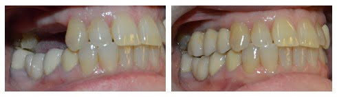 , Smile Gallery: Dental Implants