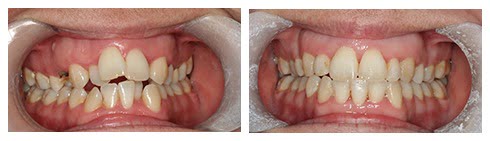 , Smile Gallery: Orthodontics