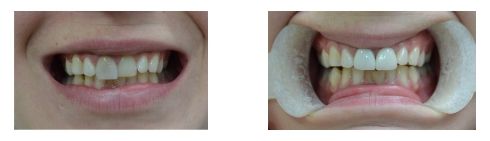 , Smile Gallery: Veneers