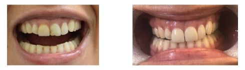 , Smile Gallery: Veneers